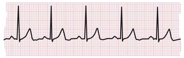 ECG